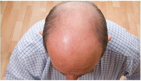 雄秃的原因1雄激素脱发脂溢性脱发,简称为"男性脱发",是一种在青春期