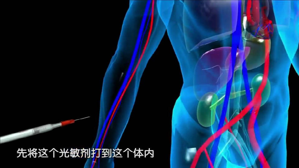什么是肿瘤光动力治疗__凤凰网