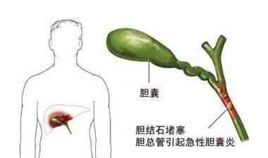 胆囊炎发作的我们应该怎么缓解疼痛？__凤凰网
