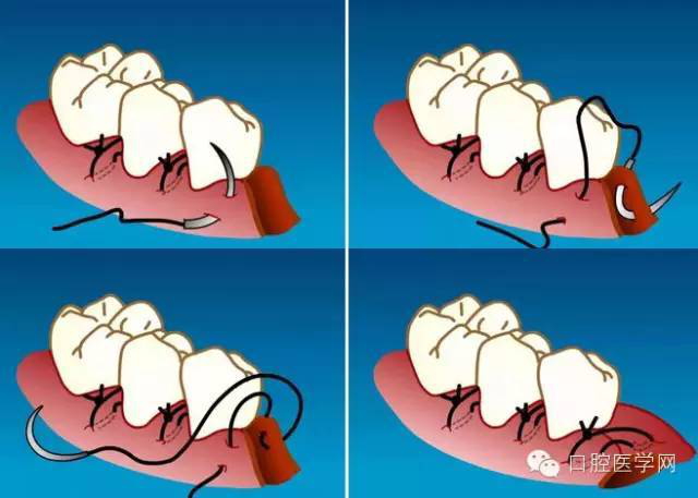 牙龈减张缝合图片