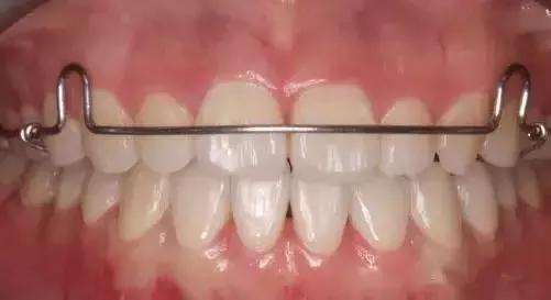 常用的保持器有哪种类型呢