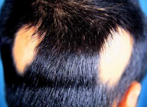 男性脱发该怎么控制,为什么越吃药脱的越厉害?