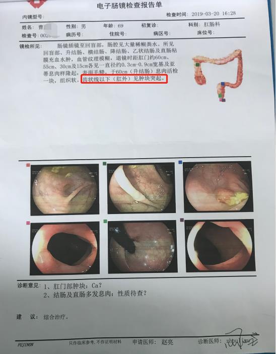 70岁低位直肠癌患者冷冻消融保肛治疗案例