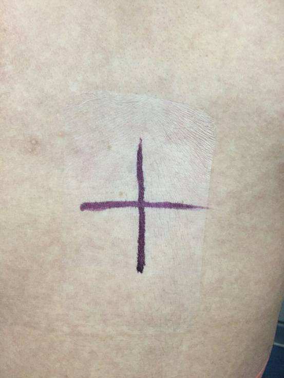 放射治疗患者及家属应注意哪些问题?