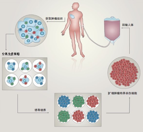 免疫细胞回输图片