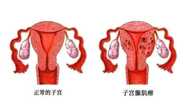 子宮肥大症和子宮腺肌症