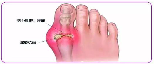 痛风多从这里开始痛如果你也是请尽早降下尿酸