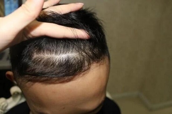 无法摆脱的遗传性脱发如何治疗才好什么方法能治愈
