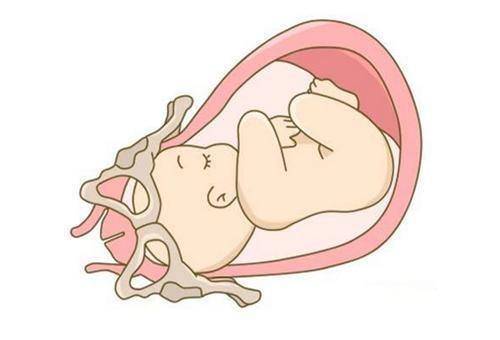 入盆是分娩的前奏,孕妈妈如何判断自己是否入盆呢?