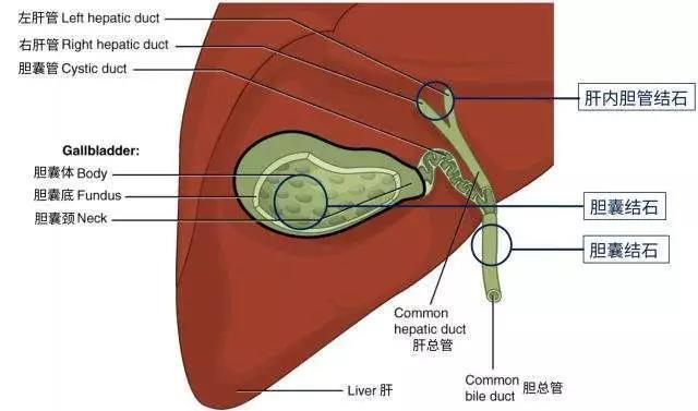 膽囊長出結石?都是你一口一口吃出來的,患上膽囊癌別怪誰