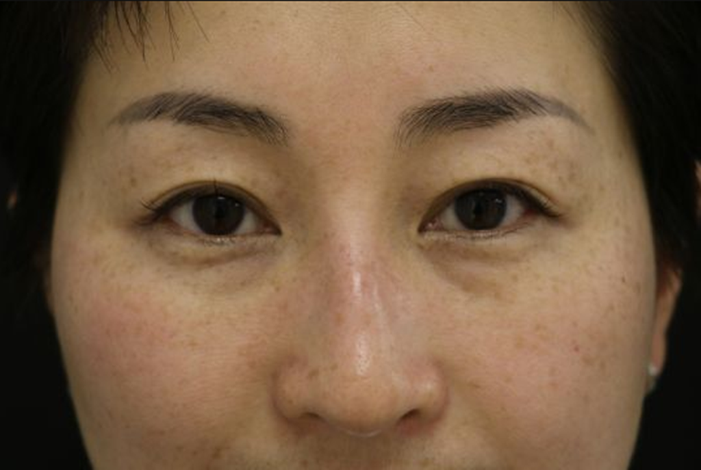 黄褐斑,中医又名"面尘","肝斑","黑肝"等,民间俗称为"蝴蝶斑".