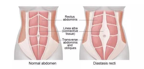 什么是腹直肌分离