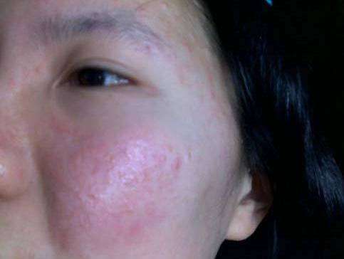 宝肤莉:油性敏感肌怎么护理 为什么会有油性敏感肌肤