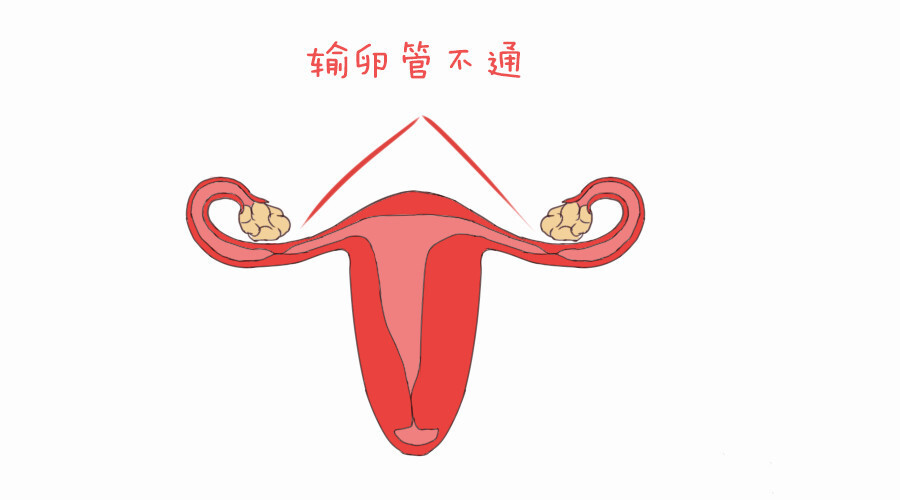 輸卵管通而不暢到底怎麼做才能懷孕