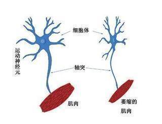 瞭解漸凍症關愛漸凍人