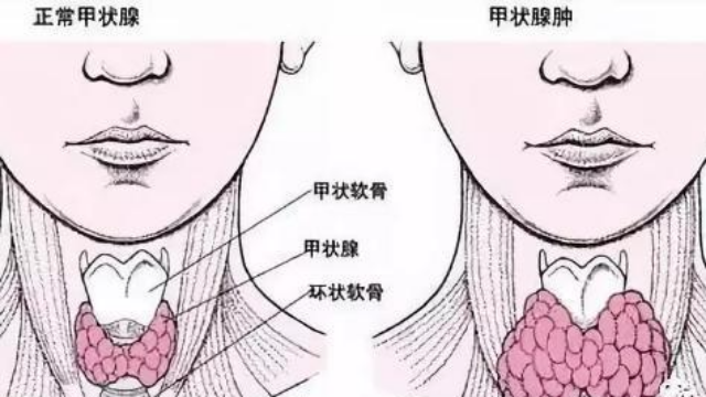 這個例子教你秒懂甲狀腺傳統手術的弊端