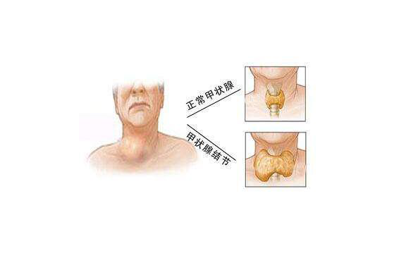 甲状腺结节怎么看出来图片