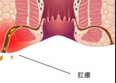 肺結核居然會導致肛瘻看完趕緊告訴身邊所有人