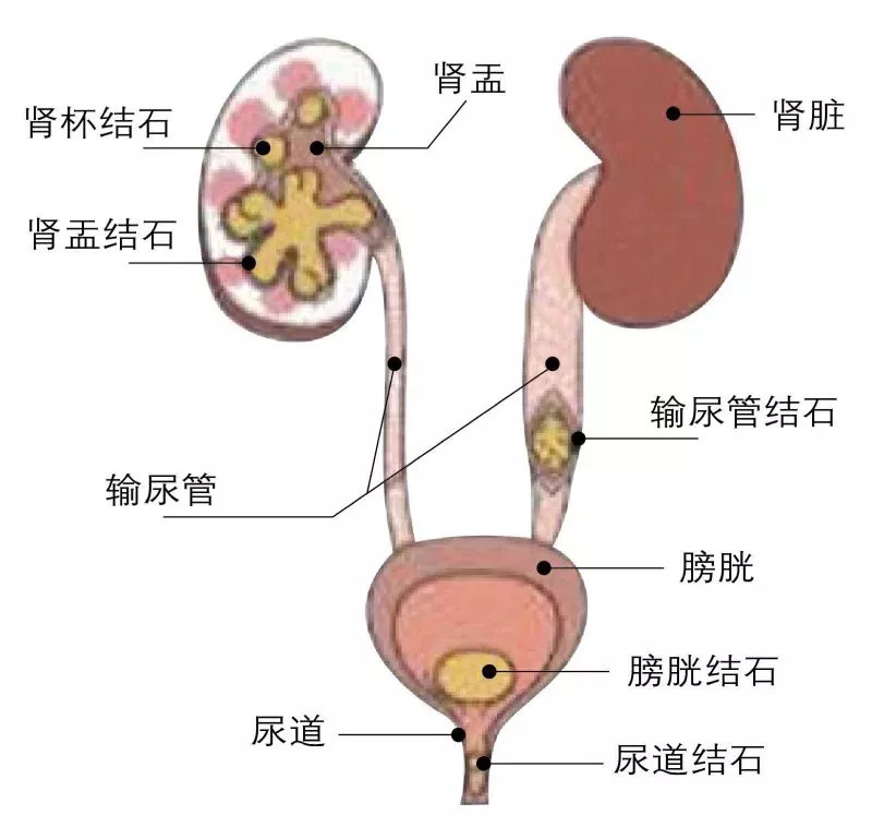人体尿路结石结构图图片