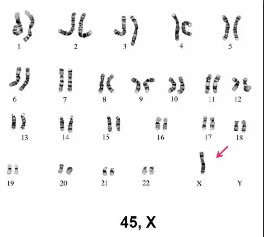 染色体报告解读