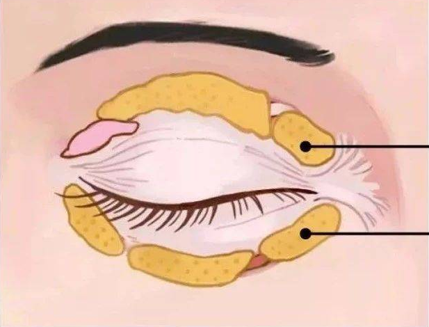 祛眼袋,医生更建议做眶隔脂肪释放法?为什么?