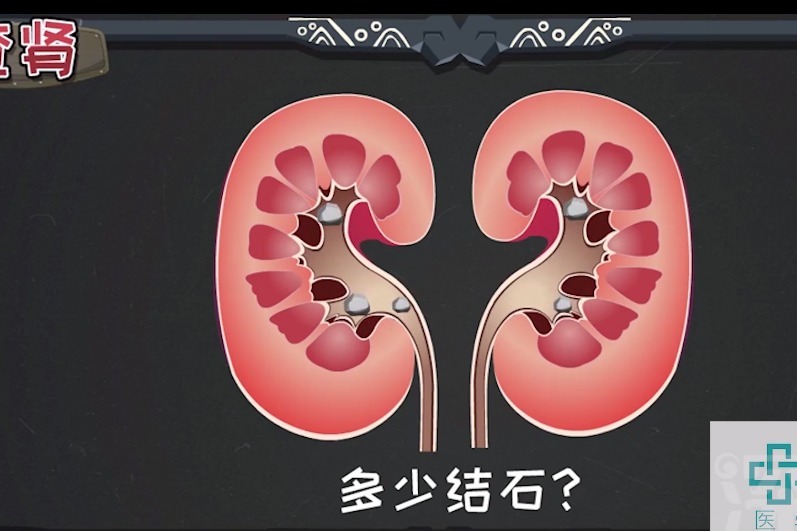 想知道腎裡頭有多少結石?具體多大?有沒有合併腎積水?