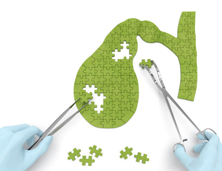 胆囊结石手术费是多少 看了这个你就知道 凤凰网