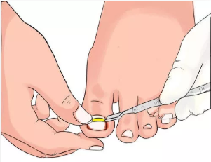 指甲经常长到肉里面,是怎么回事?