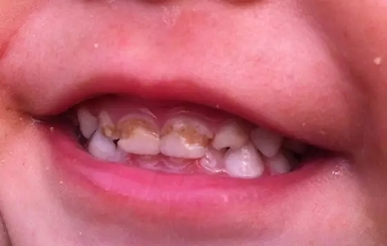 前几天一位宝妈带着才2岁宝宝来门诊,门牙上就出现环状黄色斑块,牙齿
