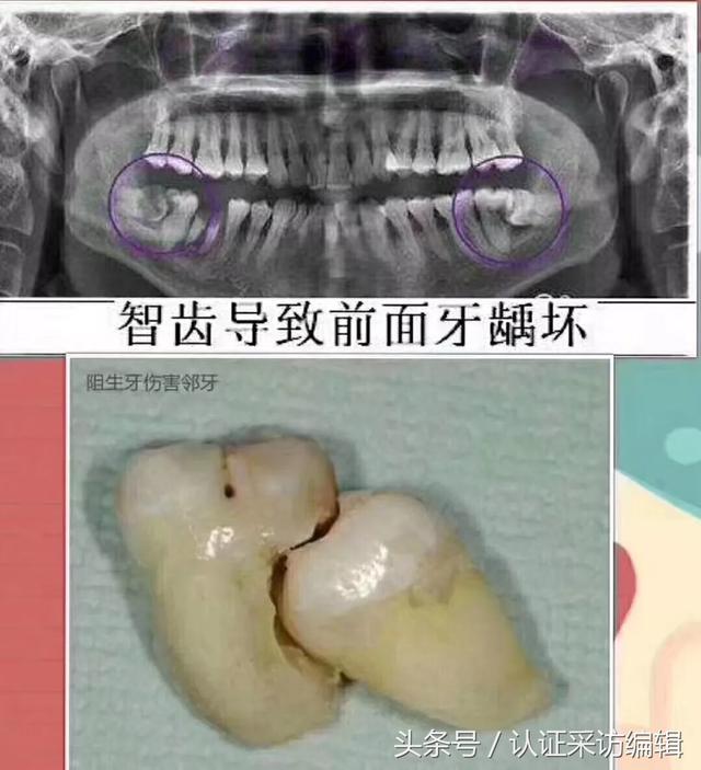 通过两个娃拔除立事牙之后,我的心得体会是