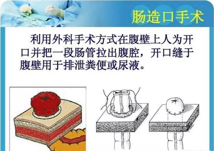 直肠癌患者:保命vs保肛--怎么选择?