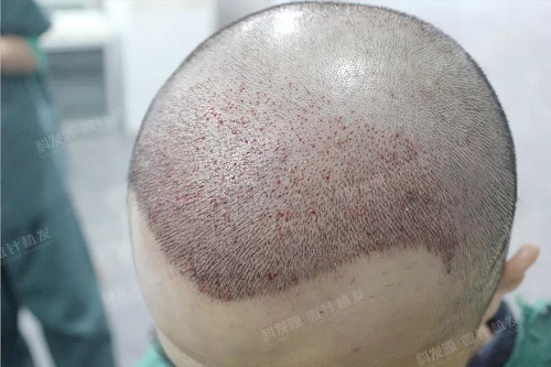 植发后头皮水肿的原因?植发后如果水肿怎么消肿比较快?