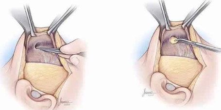 筋膜悬吊面部提升术是什么,可以保持几年?