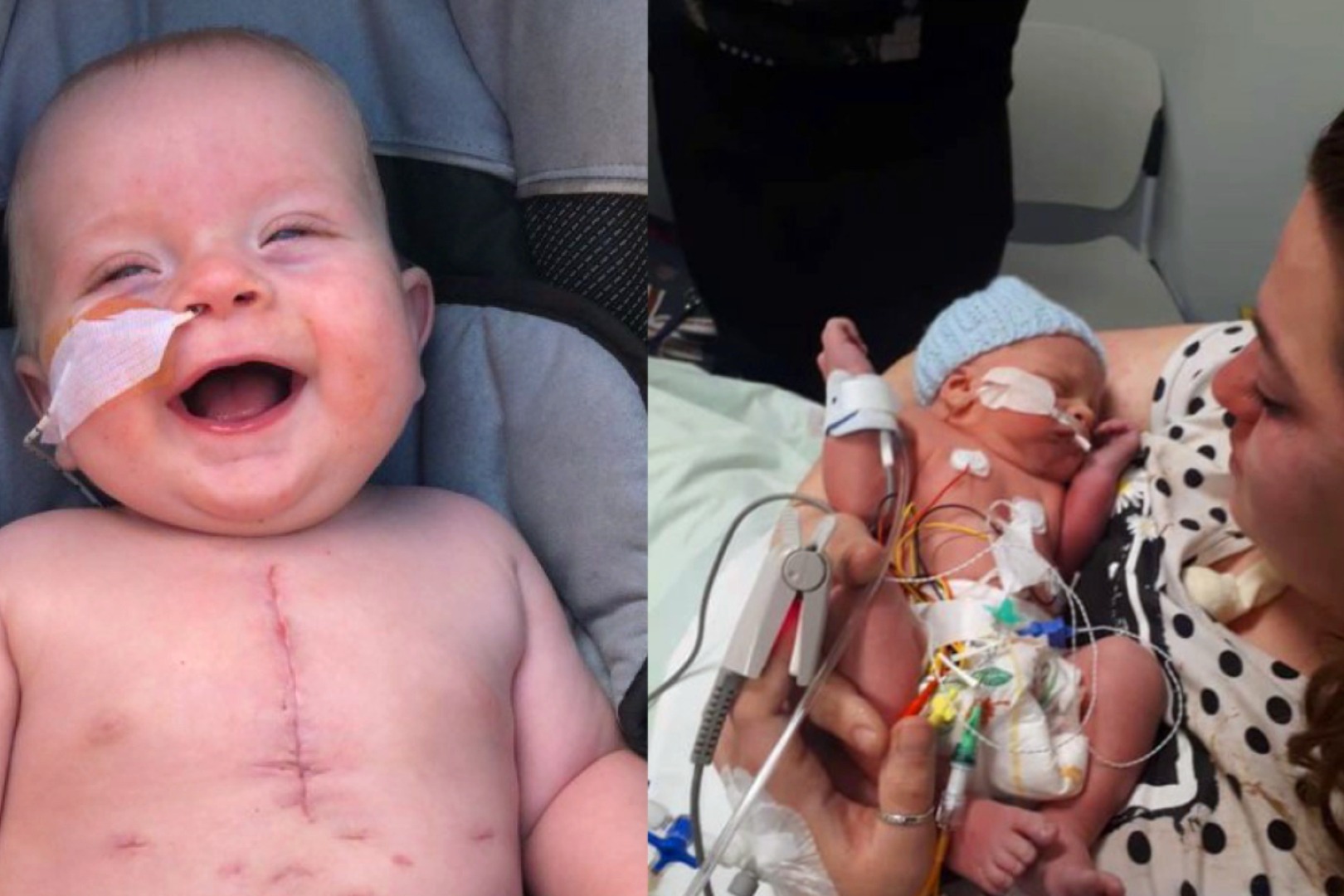 奇迹英国一男婴患有严重的心脏缺陷移植小牛心脏瓣膜获新生