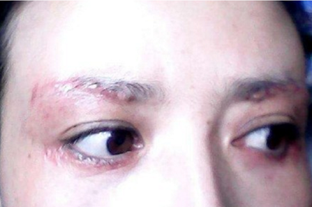 切眉术后多久疤痕消失切眉恢复要注意什么 凤凰网