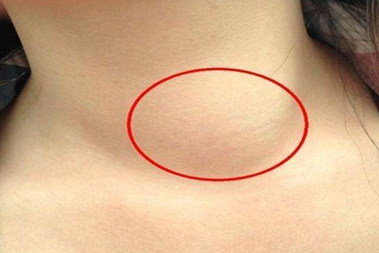 北京北城中医医院赵萍专家甲状腺囊实性结节4a怎么处理