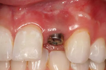 四,安装愈合基台