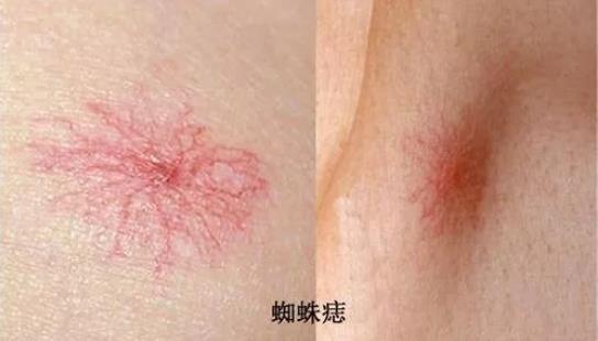 太阳穴附近出现小粉刺,以及痘痘,显示你的饮食中包含了过多的加工食品