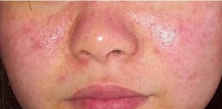 干敏肌3做2不做坚持一个月告别敏感泛红