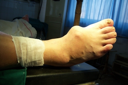 你的痛风石发展到哪个阶段了