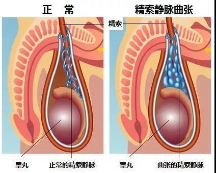 雙側精索靜脈曲張可以運動嗎