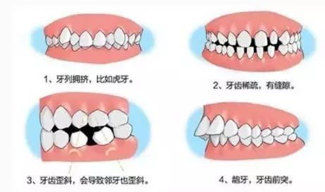 牙齿矫正的过程是如何的？矫正后痛苦悲伤多久才好？（牙齿矫正过程痛苦吗）