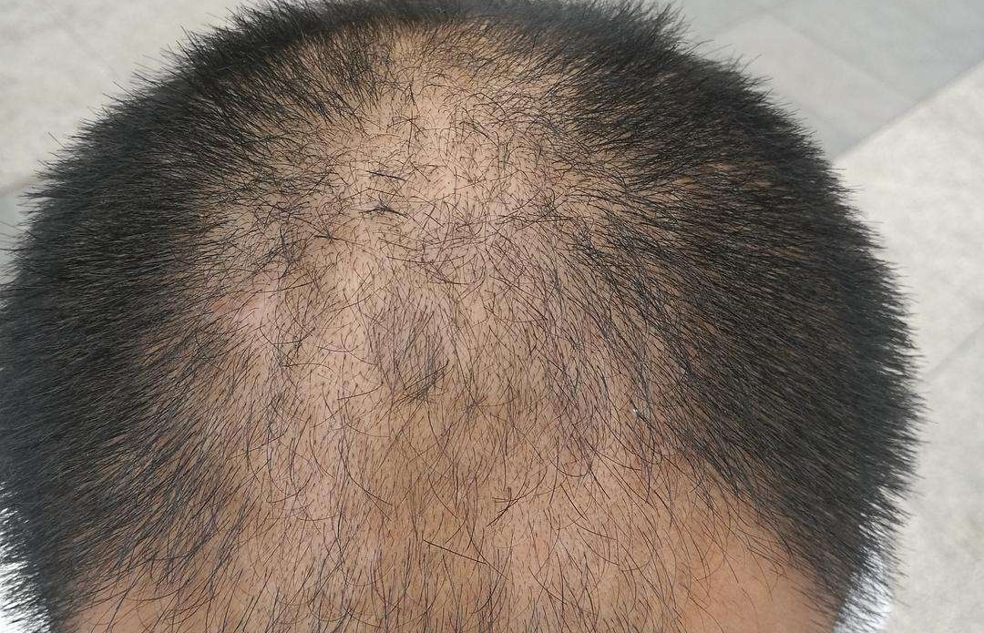 从症状来看,脱发可以分成实证和虚证