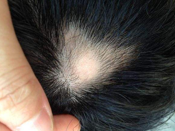 是什么原因造成斑秃的?