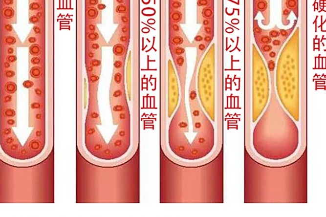 患上动脉硬化闭塞症别担心,中医研制 "五龙脱疽汤"针对血管顽疾