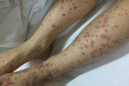 7岁女孩患上过敏性紫癜总是反复给出她这三点