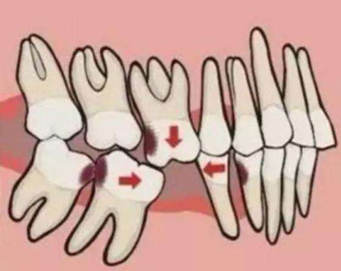 专业牙医告诉你,怎么个严重法?