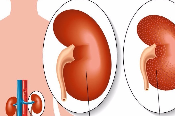 糖尿病腎病患者分享治癒經歷:用一物降血糖蛋白尿,生活充滿希望