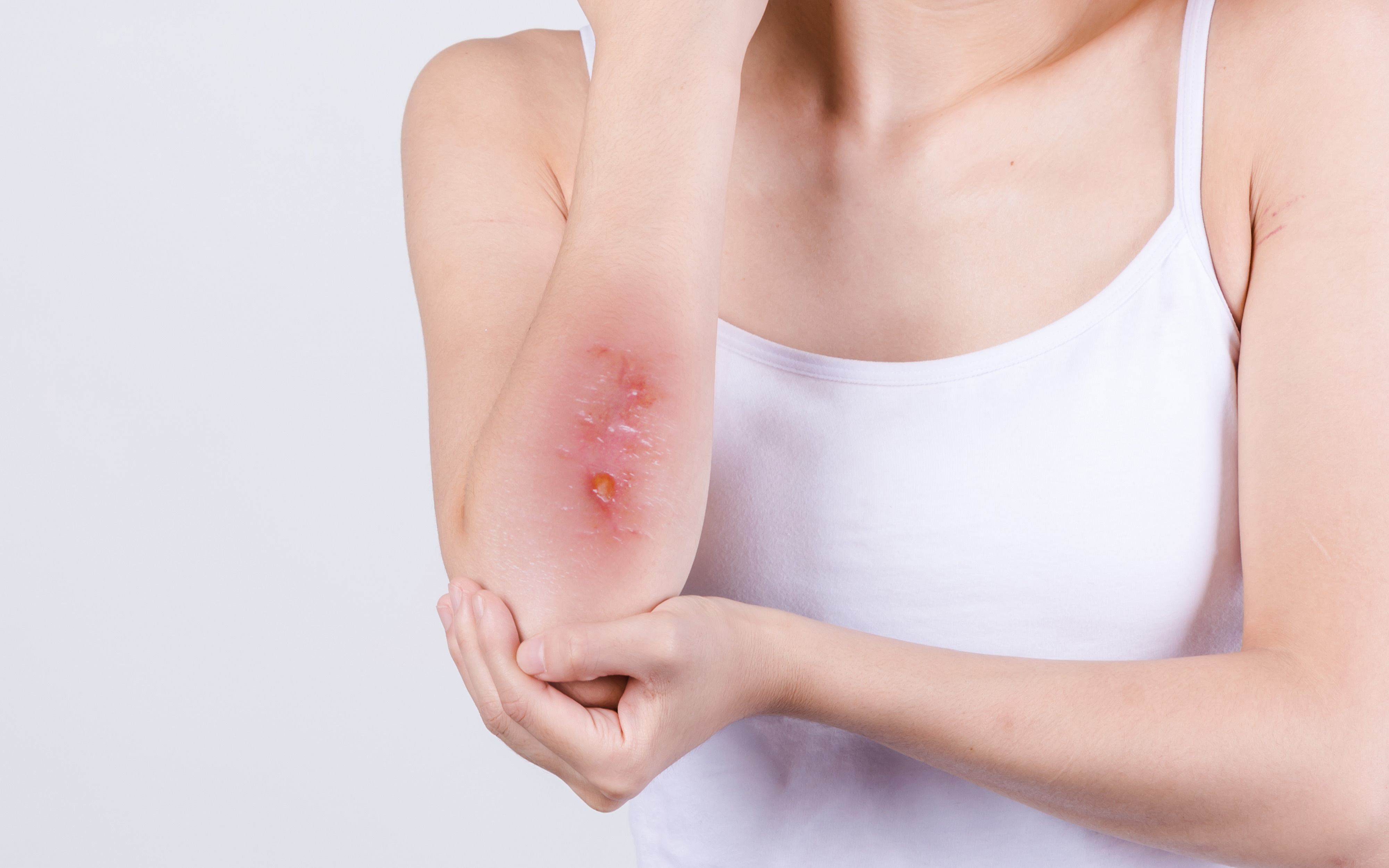 一:保持伤口干燥,清洁