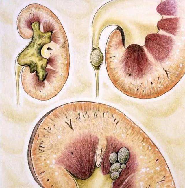 很多人都是這樣子,管不住嘴邁不開腿,其實腎結石也是一種很常見的腎病